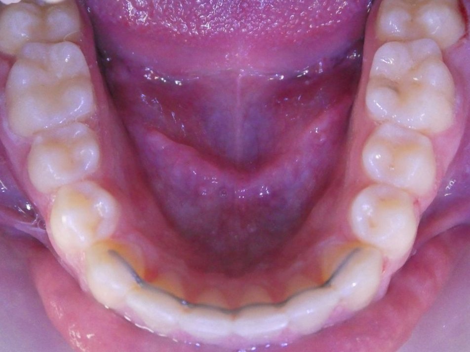 Maintien et contention orthodontique