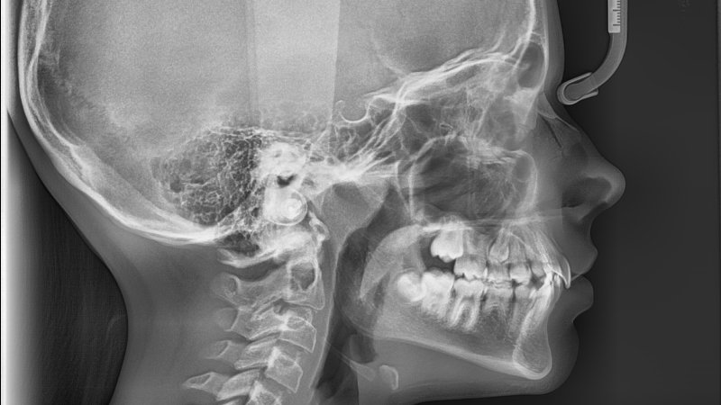 Téléradiographie de profil et de face orthodontie
